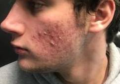 Acne Before and After Case 3 Before