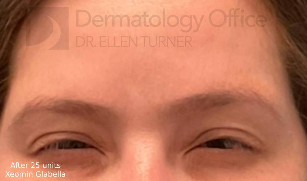 Xeomin (25 Units Glabella) Case-4 After
