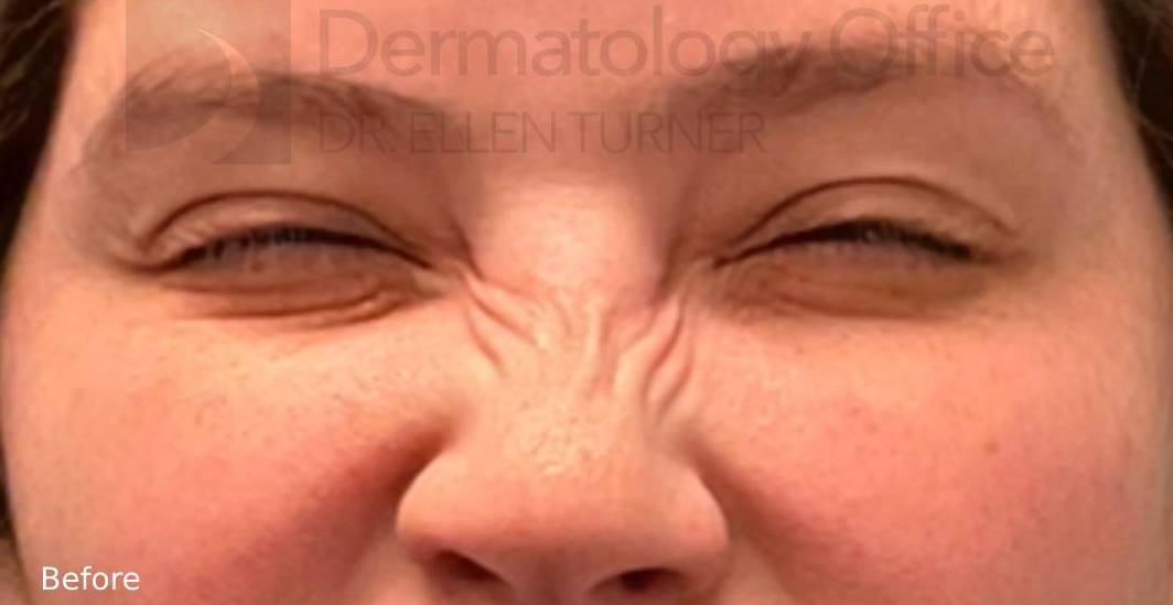 Xeomin (5 Units Bunnies) Case-5 Before