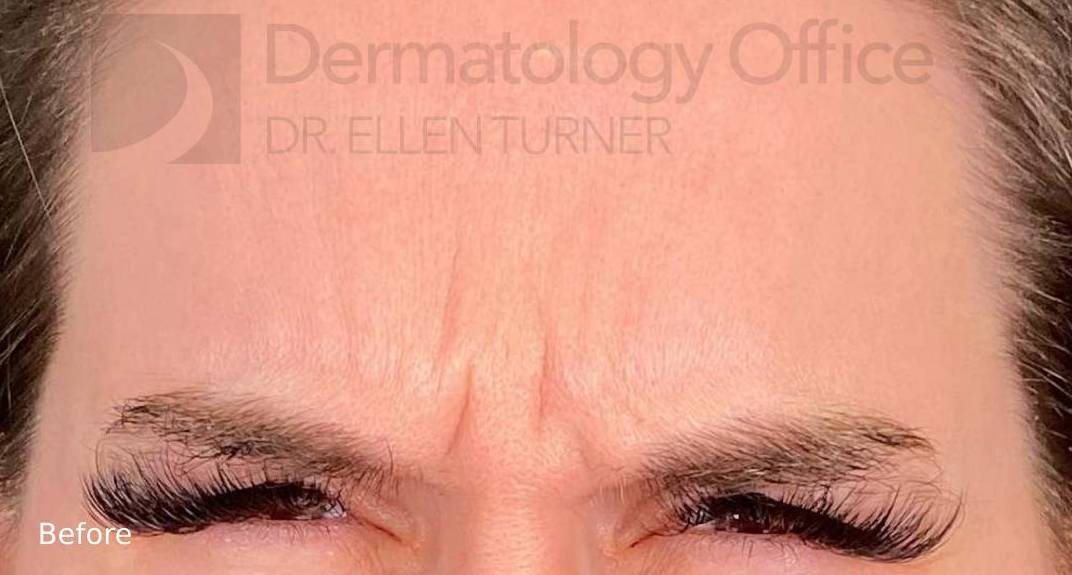 Xeomin (20 Units Glabella) Case-6 Before