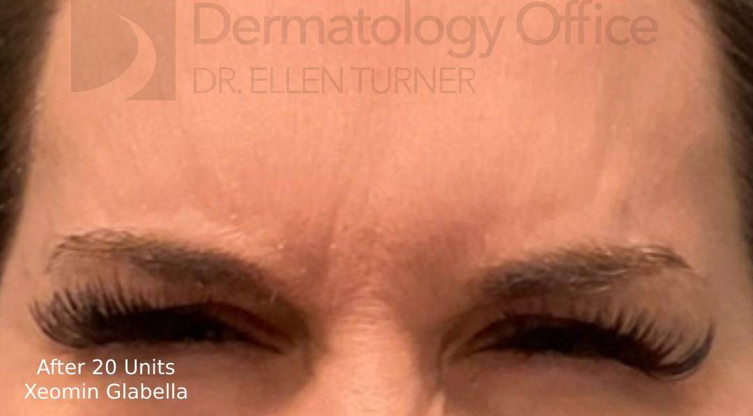 Xeomin (20 Units Glabella) Case-6 After