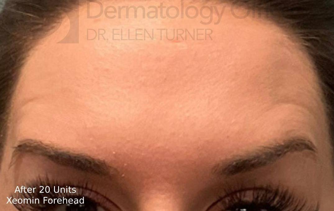 Xeomin (20 Units Forehead) Case-7 After