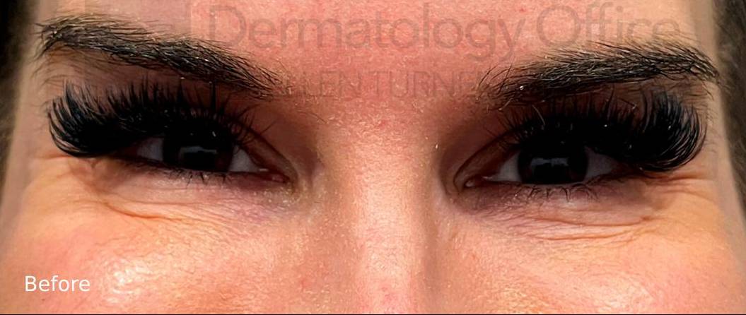 Xeomin (10 Units Crows Feet) Case-8 Before