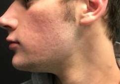 Acne Before and After Case 3 After