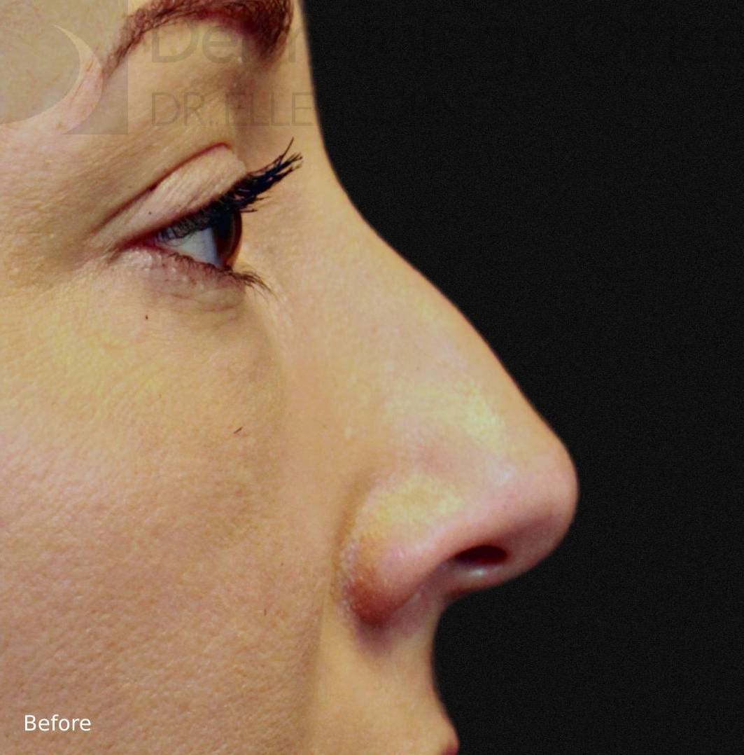 Injectable Rhinoplasty (1 Syringe Voluma) Case-4 Before