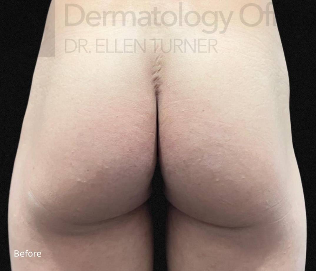 Radiesse (40 Syringes) Before and After Case-43 Before