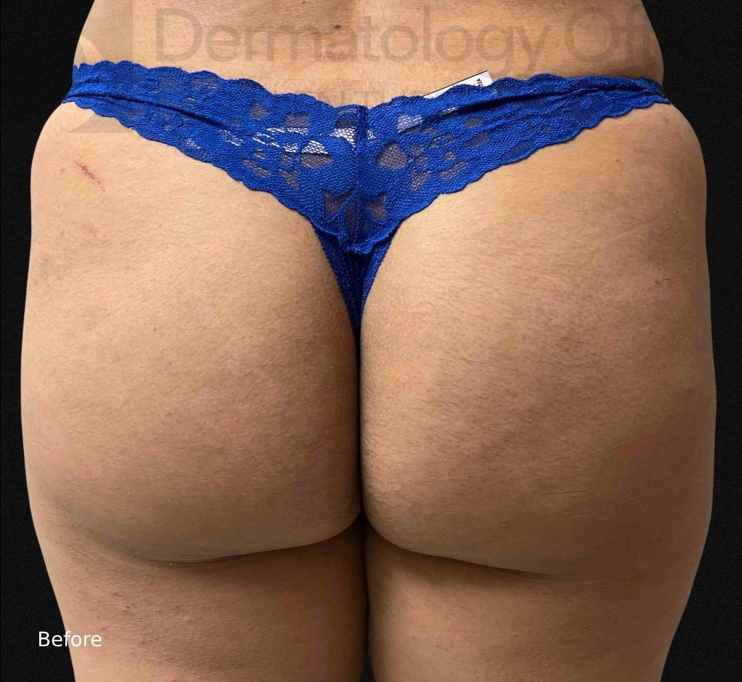 Radiesse (25 Syringes) Before and After Case-6 Before