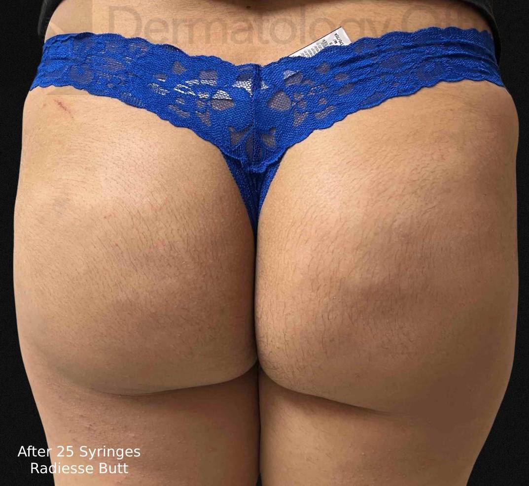 Radiesse (25 Syringes) Before and After Case-6 After