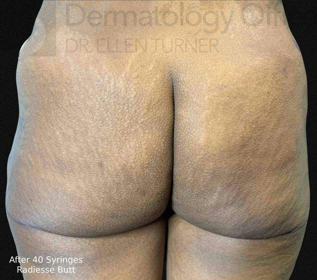 Radiesse (40 Syringes) Before and After Case-10 After