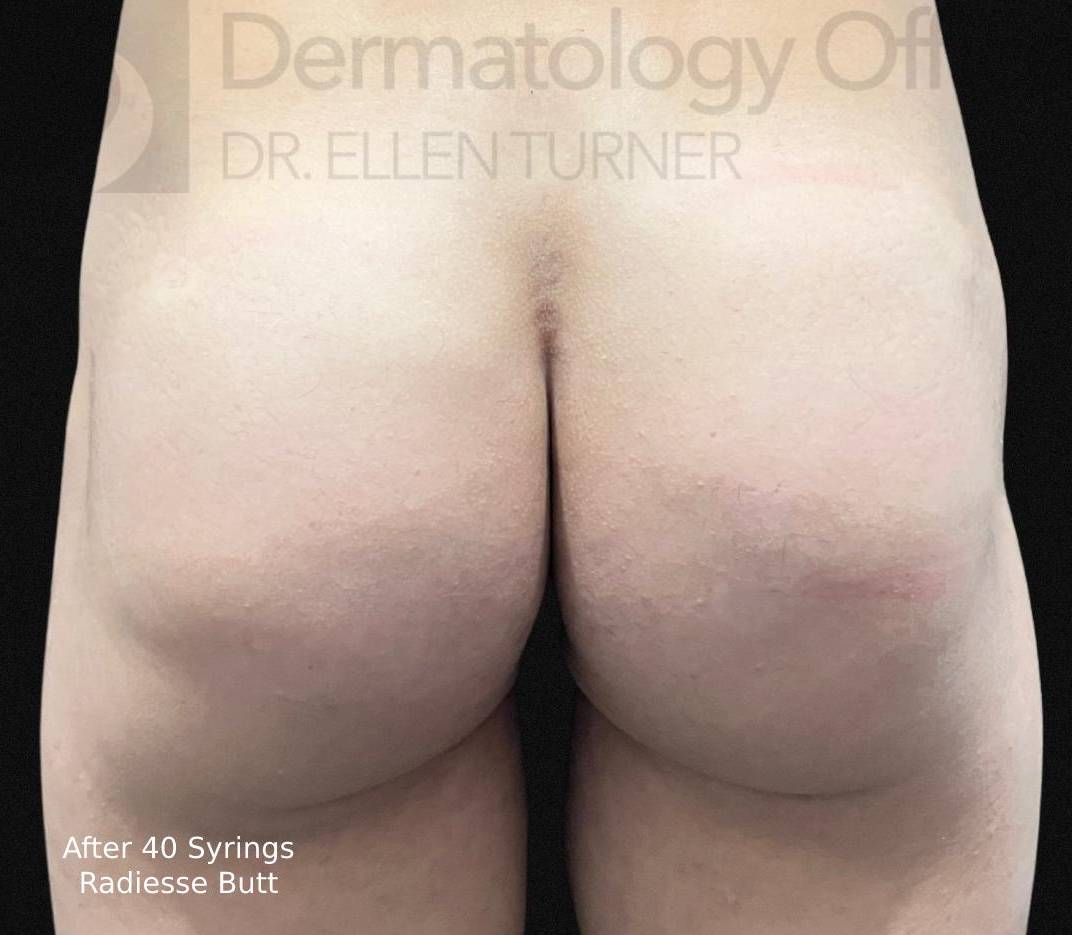 Radiesse (40 Syringes) Before and After Case-11 After