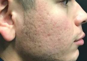 Acne Before and After Case 4 After