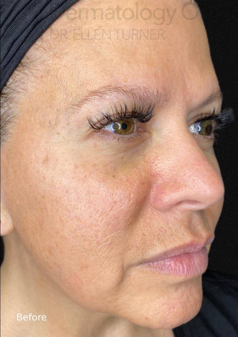 Juvederm (2 Syringes) Case-8 Before
