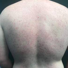 Acne Before and After Case 5 After