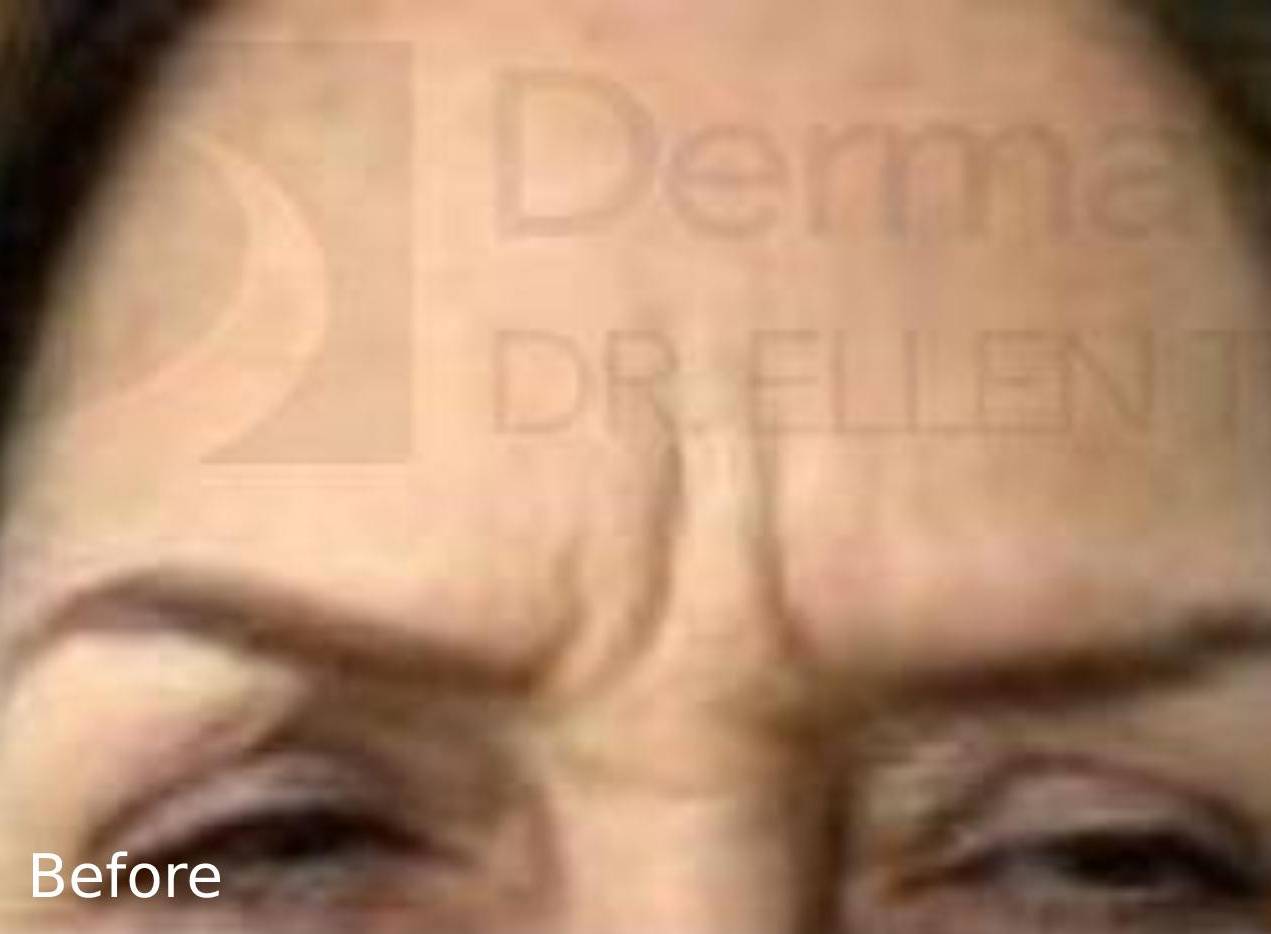 BOTOX (20 Unites) Case-2 Before