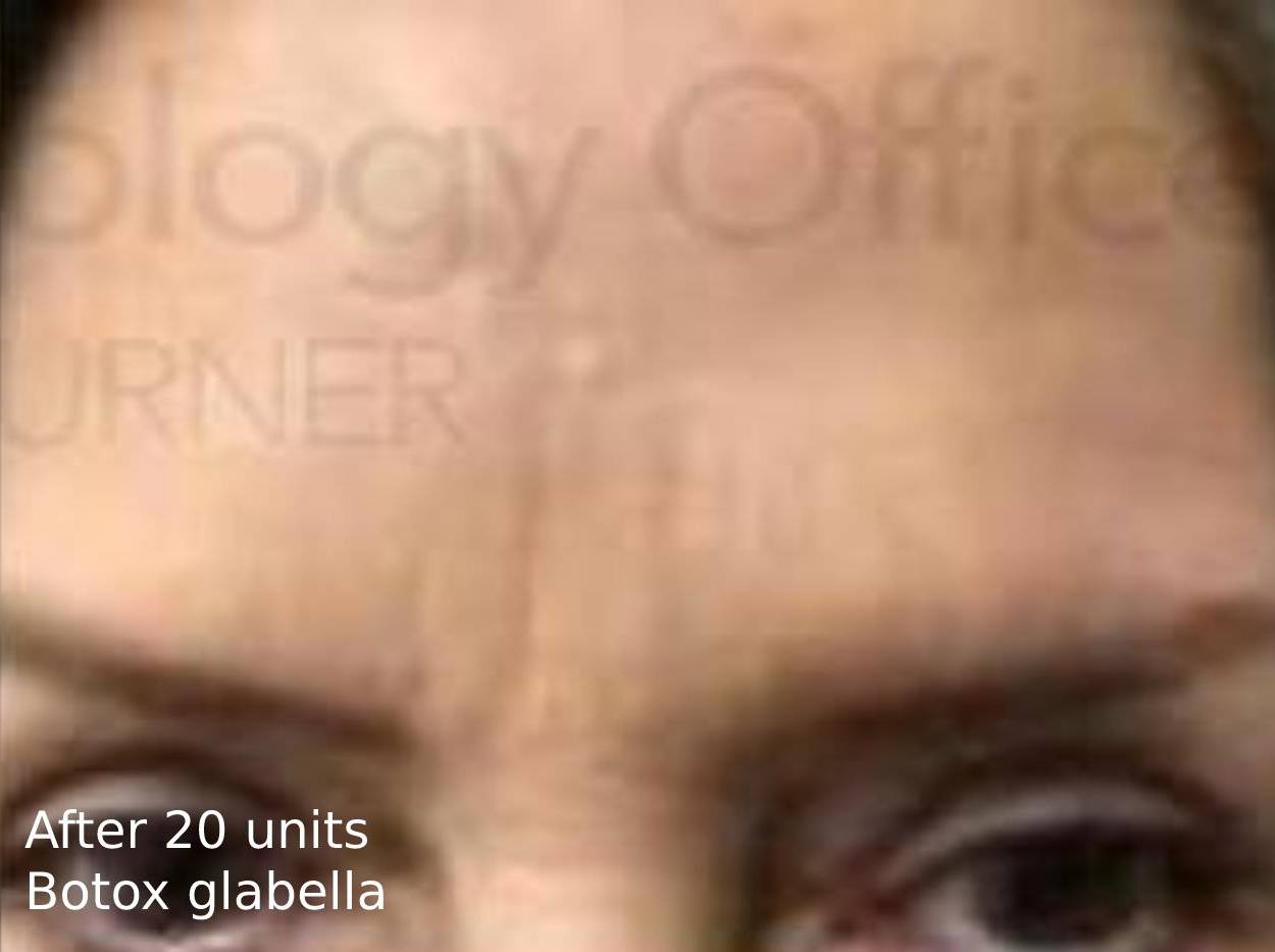 BOTOX (20 Unites) Case-2 After