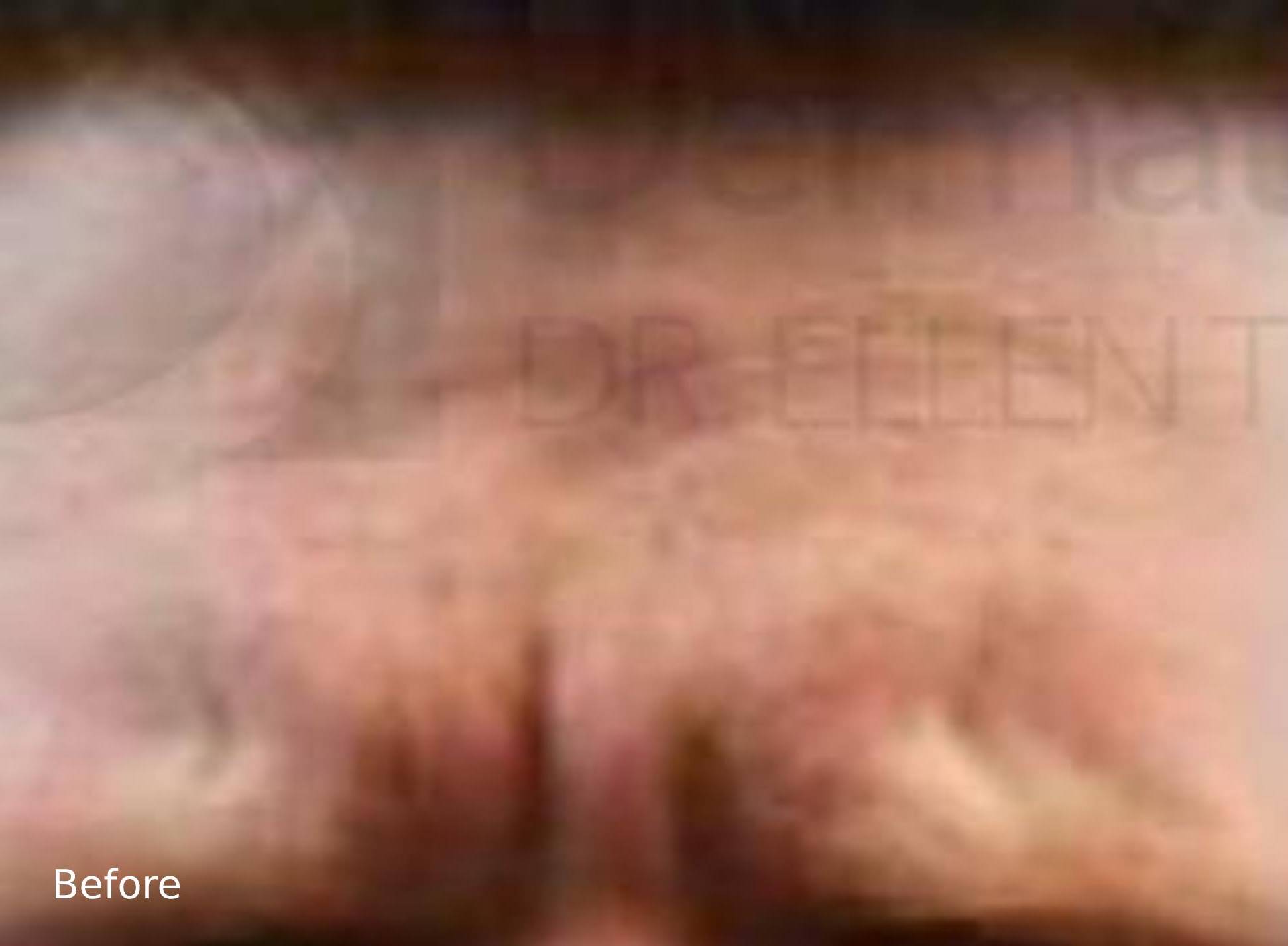 BOTOX (25 Units) Case-3 Before