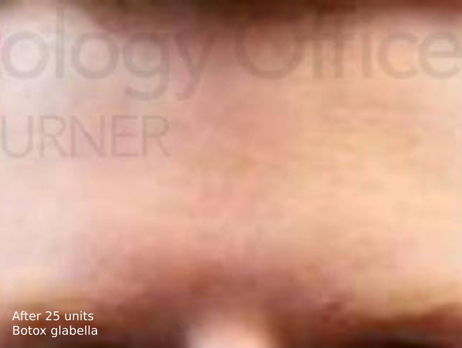 BOTOX (25 Units) Case-3 After