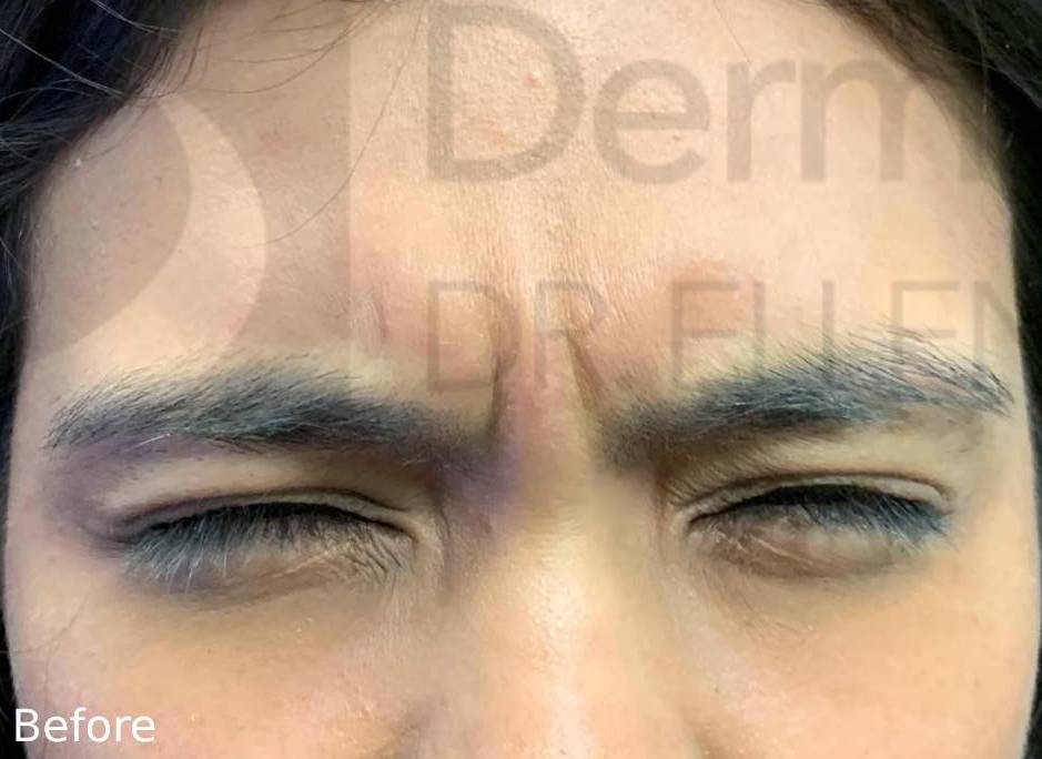Botox (20 Units) Case 4 Before