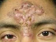 Acne Before and After Case 6 Before