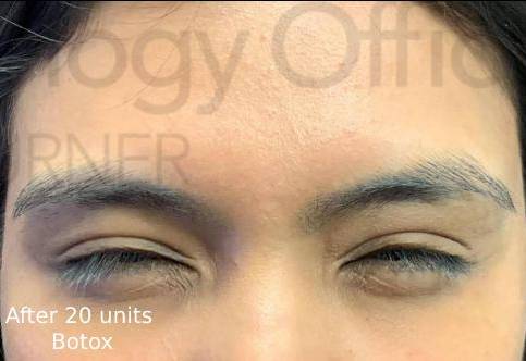 Botox (20 Units) Case 4 After
