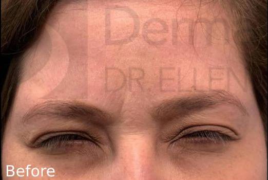 Botox (20 Units) Case 5 Before