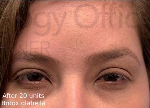 Botox (20 Units) Case 5 After