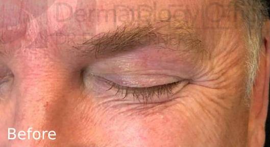 Botox (25 Units) Case-6 Before