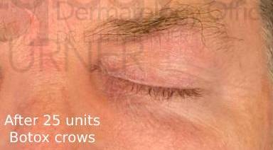 Botox (25 Units) Case-6 After