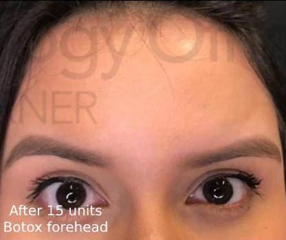 Botox (15 Units) Case 7 After