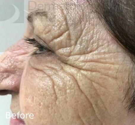 Botox (20 Units) Case-8 Before