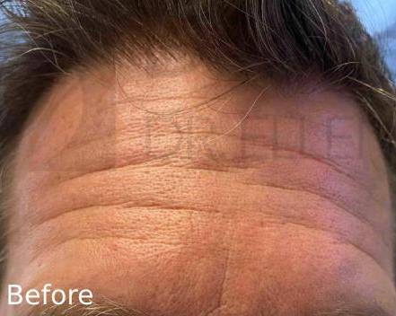 Botox (20 Units) Case 9 Before