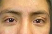 Acne Before and After Case 6 After