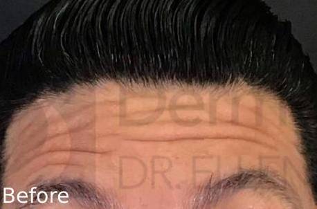Botox (25 Units) Case 11 Before