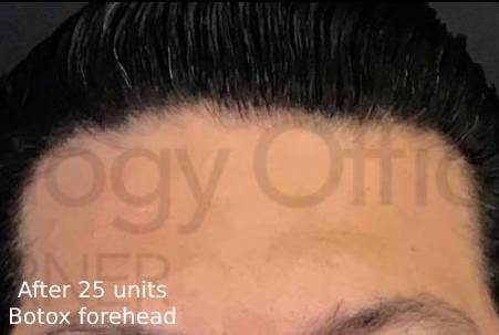 Botox (25 Units) Case 11 After
