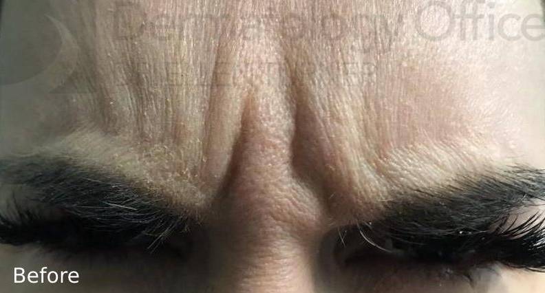 Botox (15 Units) Case 12 Before