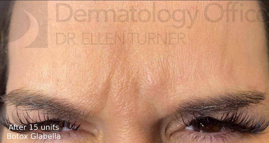 Botox (15 Units) Case 12 After