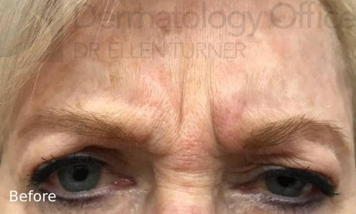Botox (25 Units) Case 13 Before