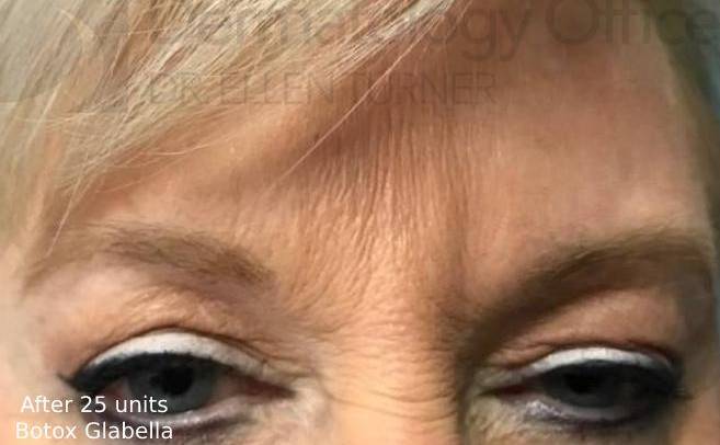 Botox (25 Units) Case 13 After