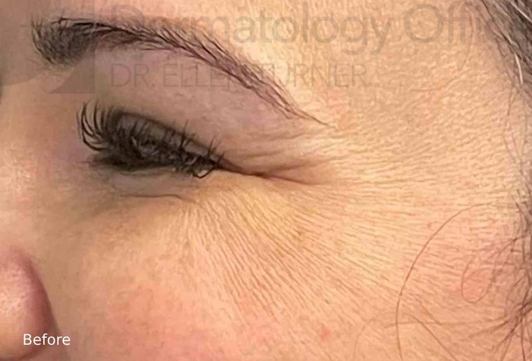 Botox (25 Units) Case 14 Before