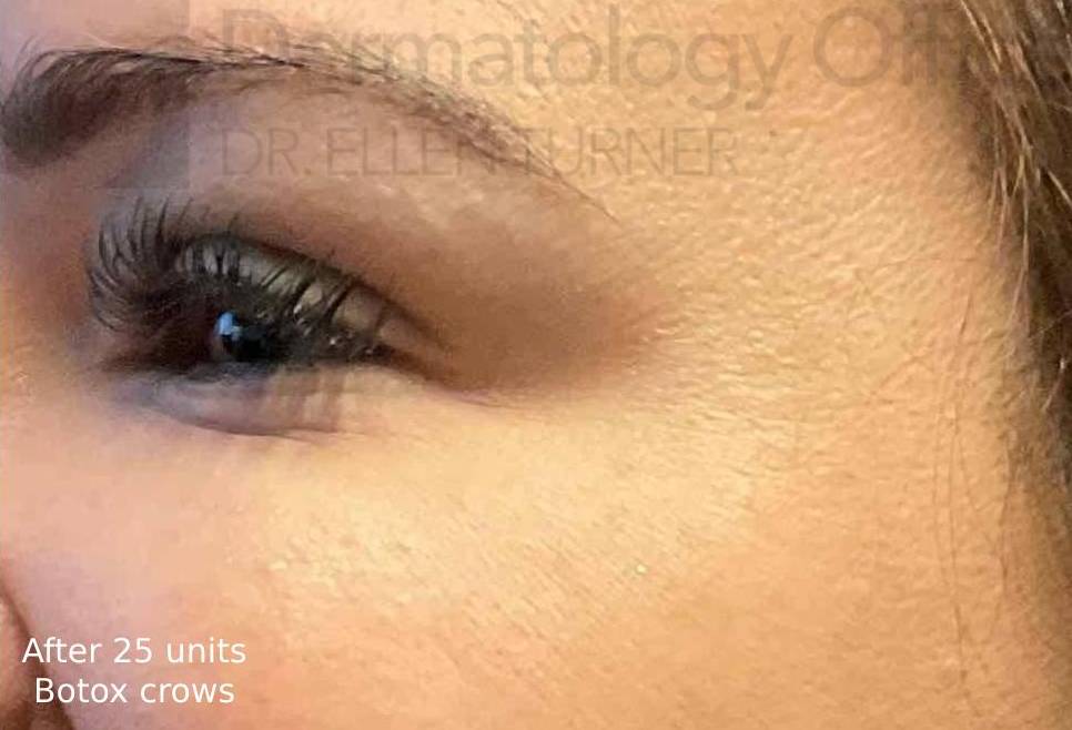 Botox (25 Units) Case 14 After