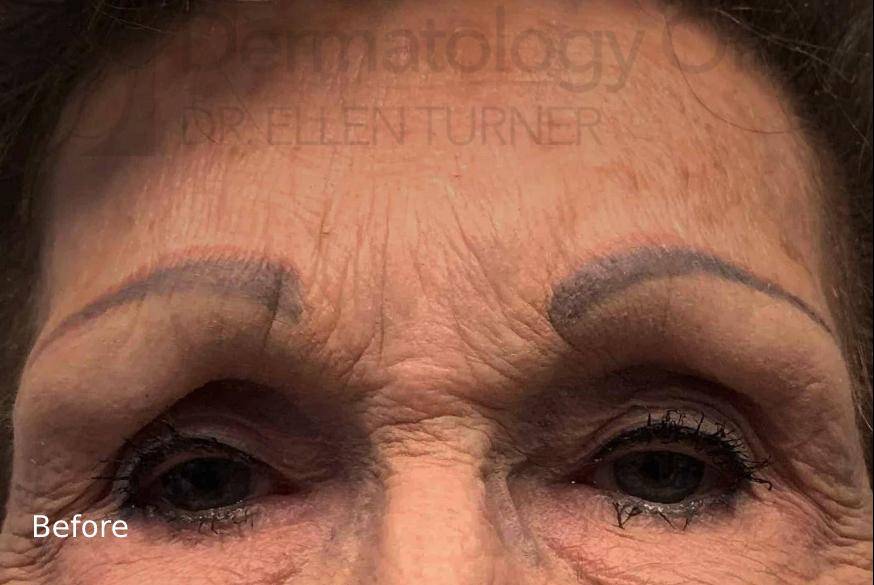 Botox (55 Units) Case 15 Before