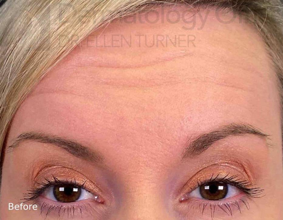 Botox (45 Units) Case 16 Before