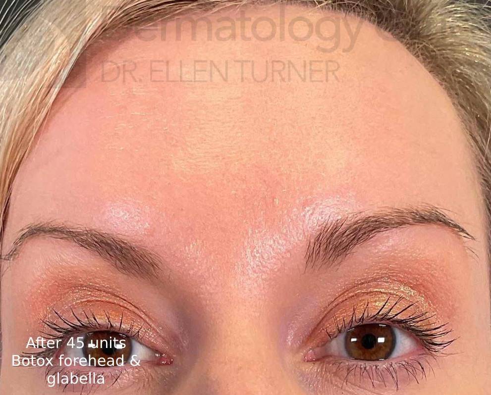 Botox (45 Units) Case 16 After