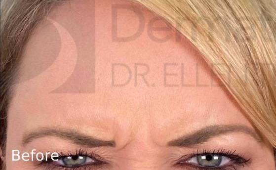 Botox (75 units) Case-17 Before