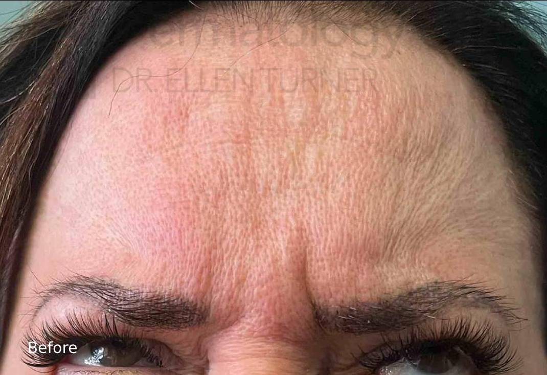 Dysport Before & After Case-1 Before