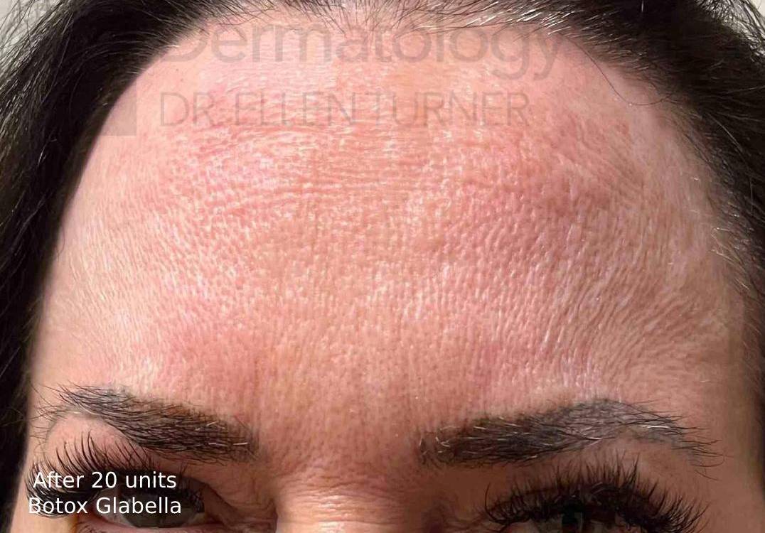 Dysport Before & After Case-1 After