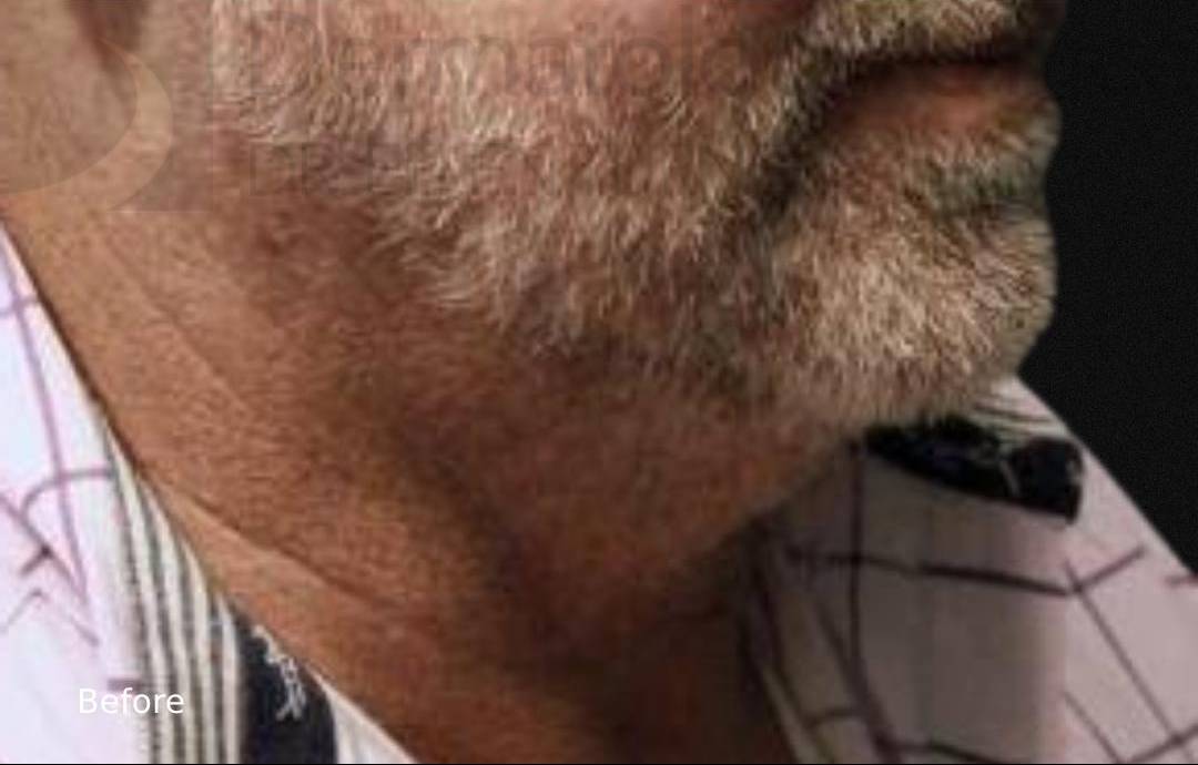 Kybella (2 Series) Before and After Case 1 Before