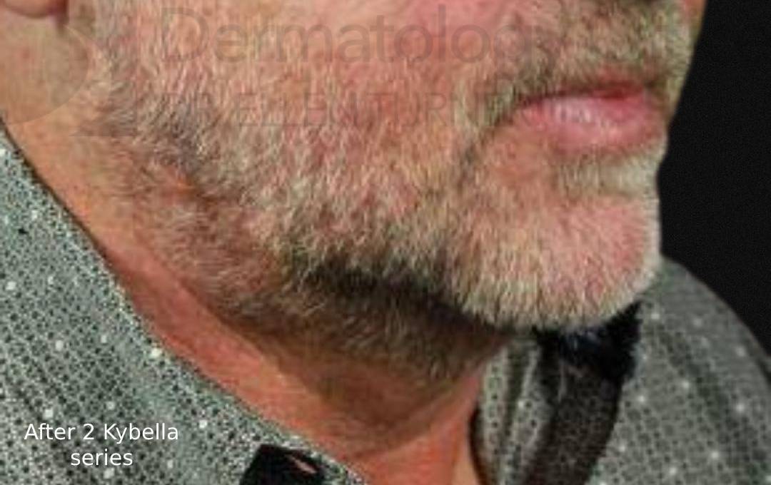 Kybella (2 Series) Before and After Case 1 After