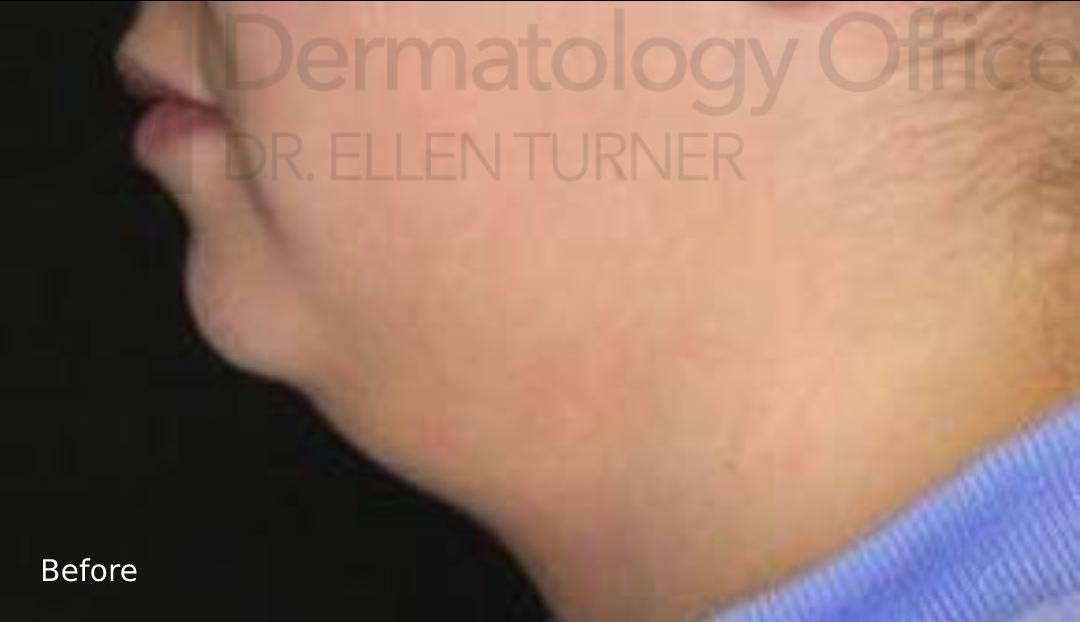 Kybella (2 Series) Before and After Case 2 Before