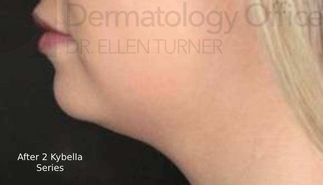 Kybella (2 Series) Before and After Case 2 After